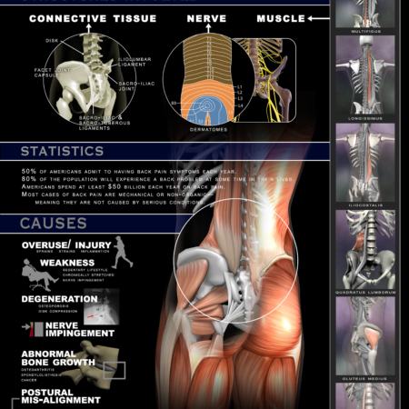 Back pain poster