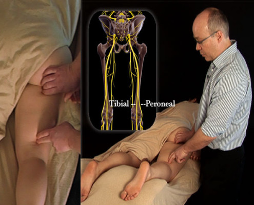 Nerve mobilization for the tibial-nerve