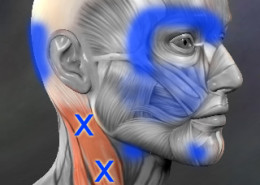 Sternocleidomastoid trigger points