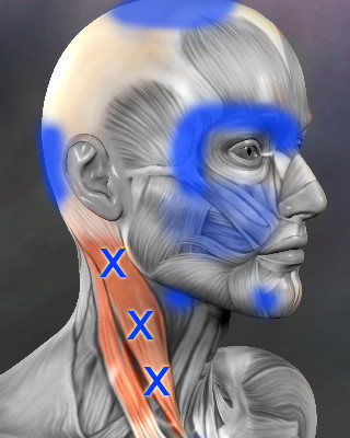 Sternocleidomastoid trigger points