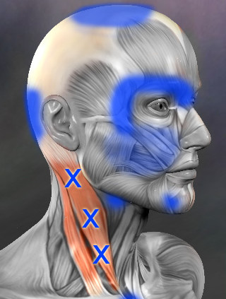 Sternocleidomastoid trigger points