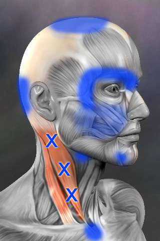 Sternocleidomastoid trigger points