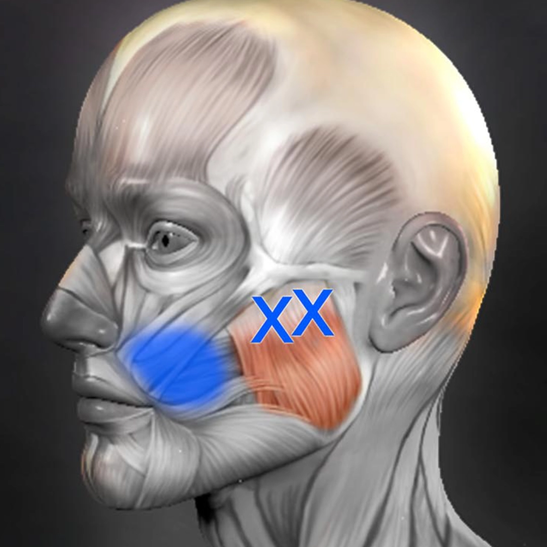 trigger point location on the masseter muscle, showing the side of the cranium