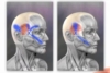 temporalis trigger point location